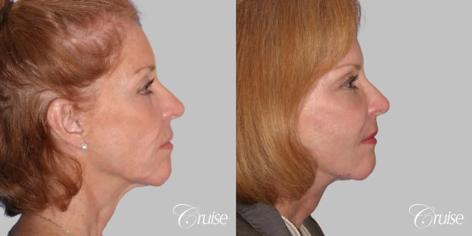 Facelift, Necklift, Temple Lift, Fat Transfer - Before and After 3