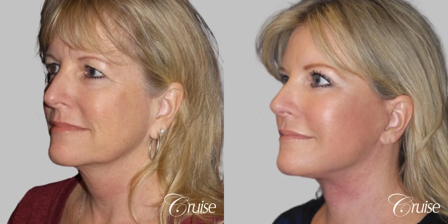 Face Lift surgery Newport Beach Orange County - Before and After 2