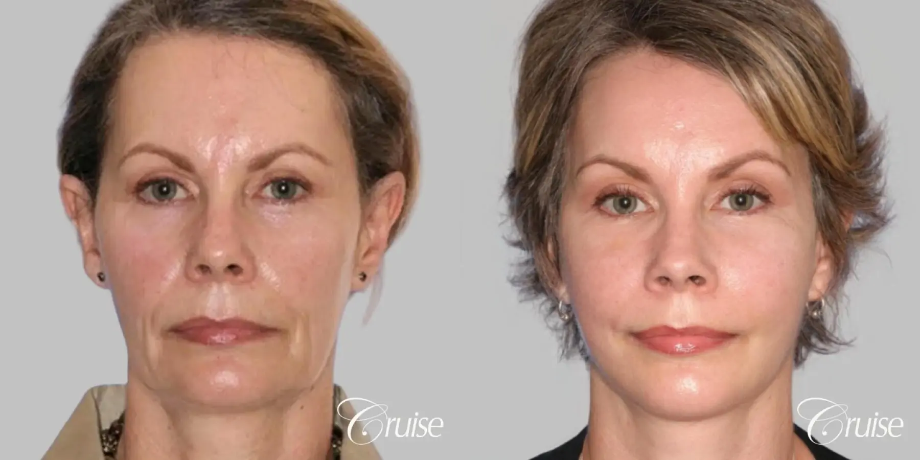 Facelift in Newport Beach, CA - Before and After 1