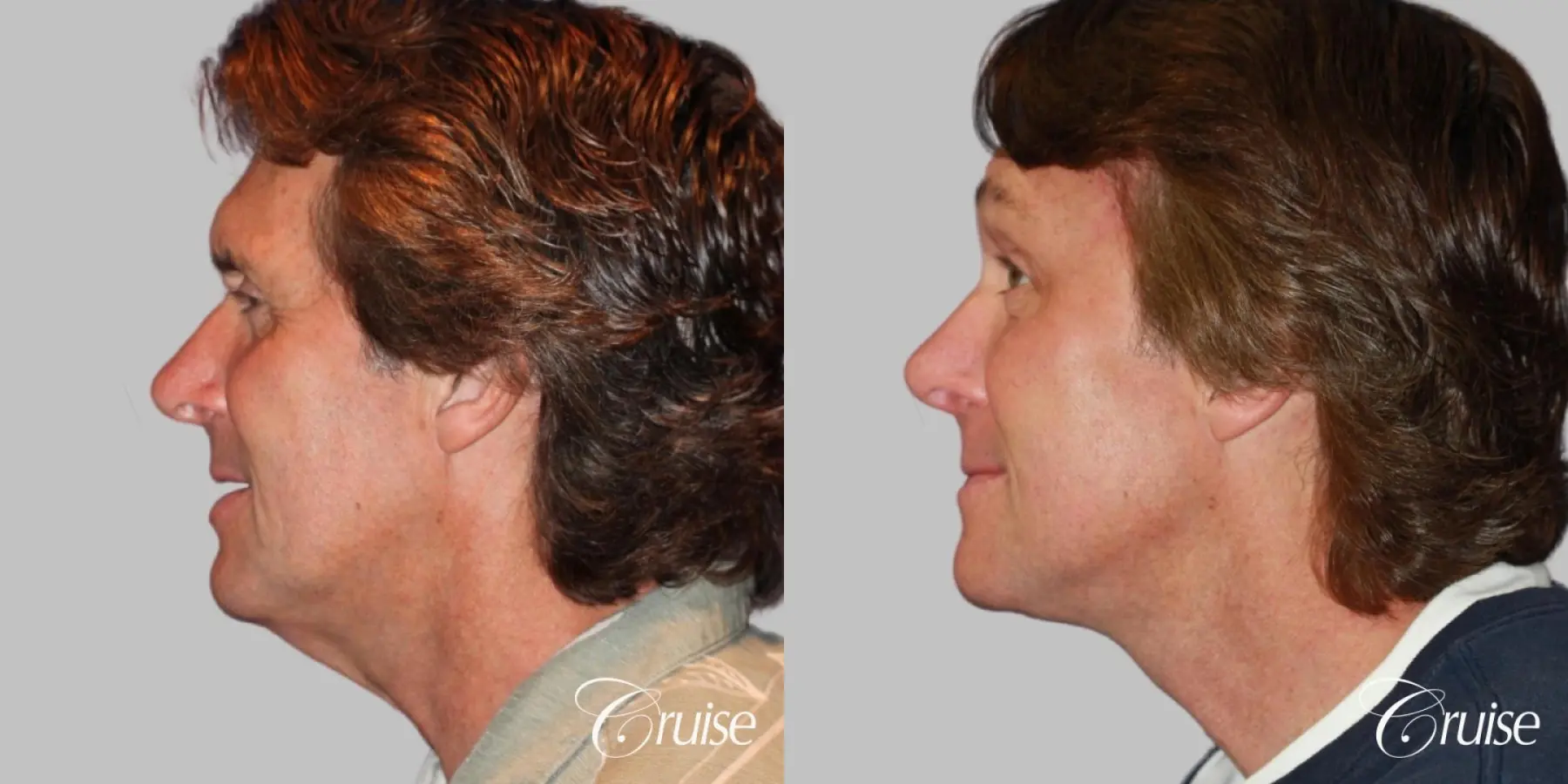 Neck Lift with Liposuction Jawline - Before and After 2