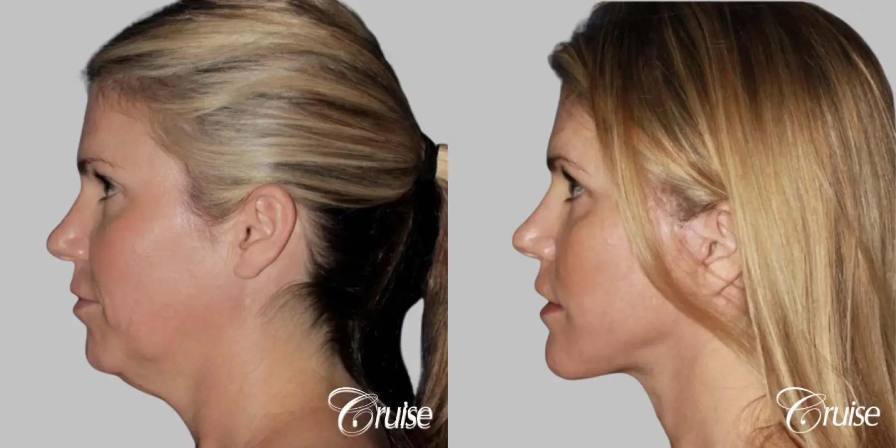 lower facelift with chin liposuction - Before and After 2