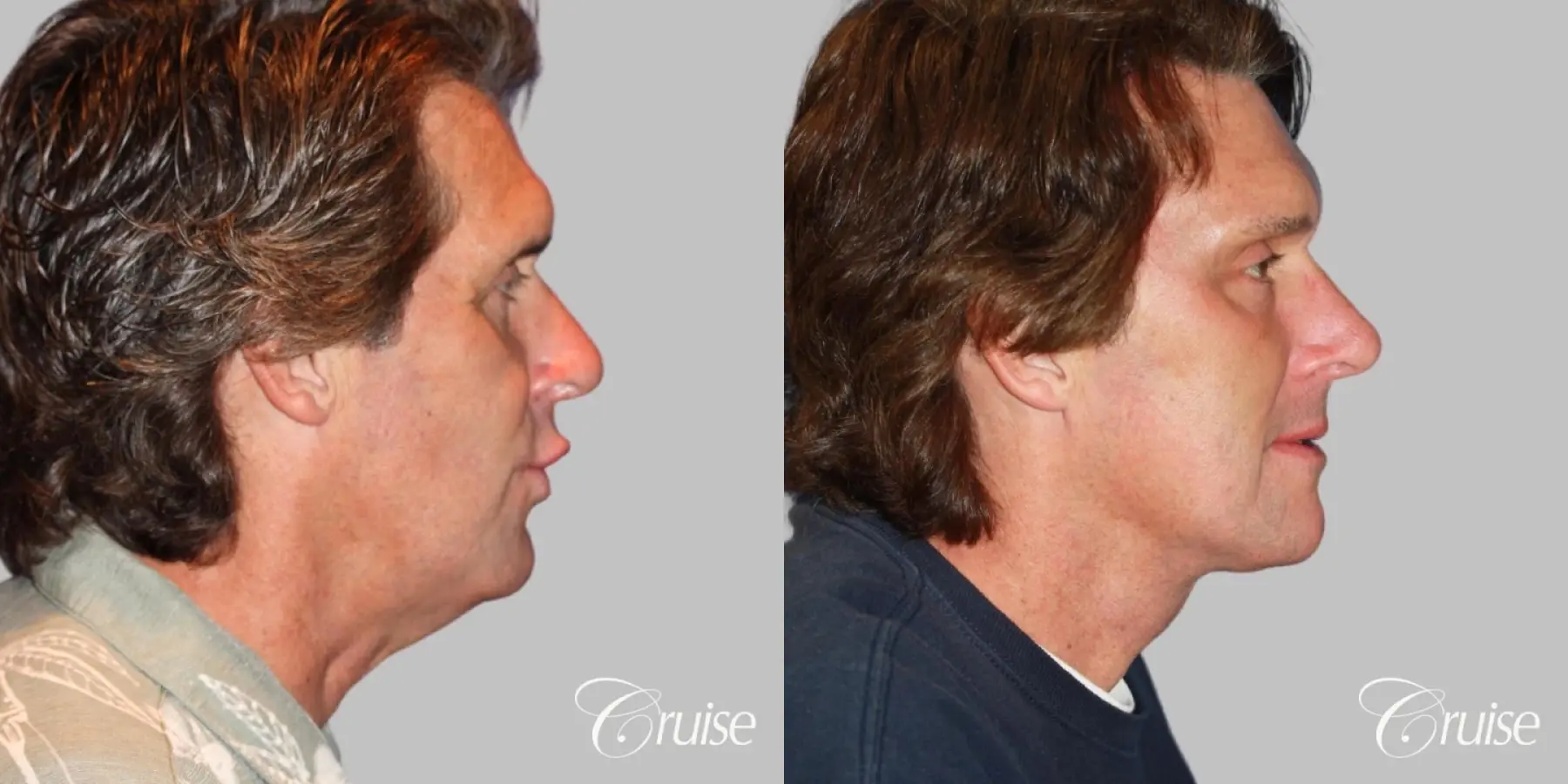 Neck Lift with Liposuction Jawline - Before and After 3