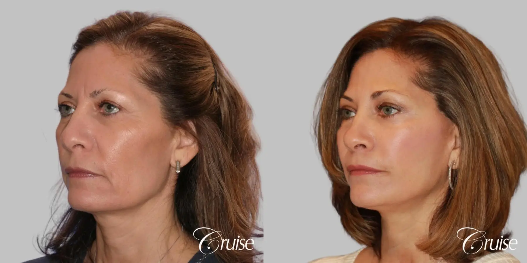 Face Lift, Fat Transfer, Temple Lift - Before and After 2