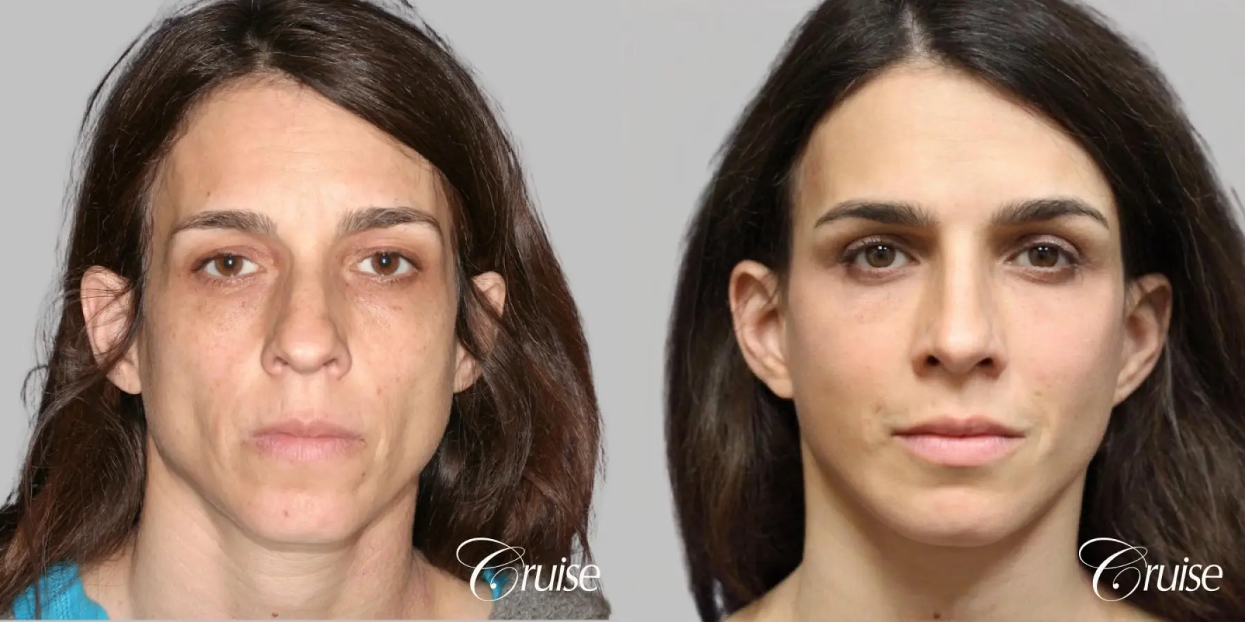 complete facial rejuvenation orange county - Before and After 1