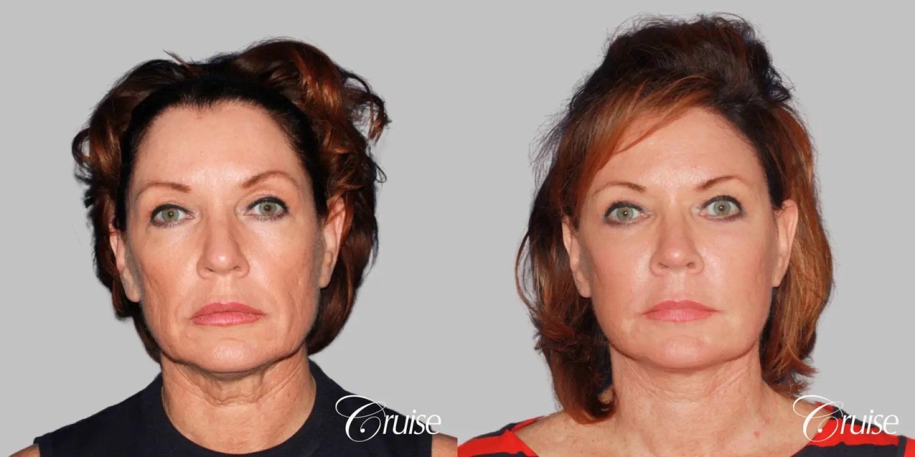 lower face and neck lift dr. joseph cruise - Before and After 1