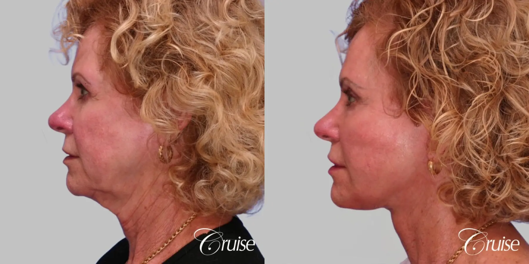 Facelift, Neck Midline Plication - Female Patient - Before and After 2