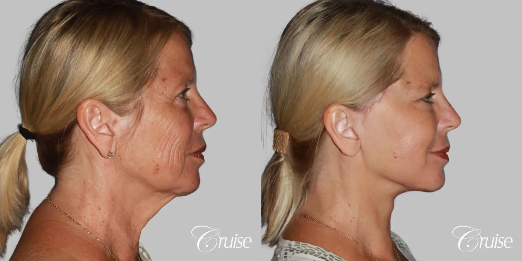 Face Lift, Neck Lift, Neck Midline Plication Surgery - Before and After 2