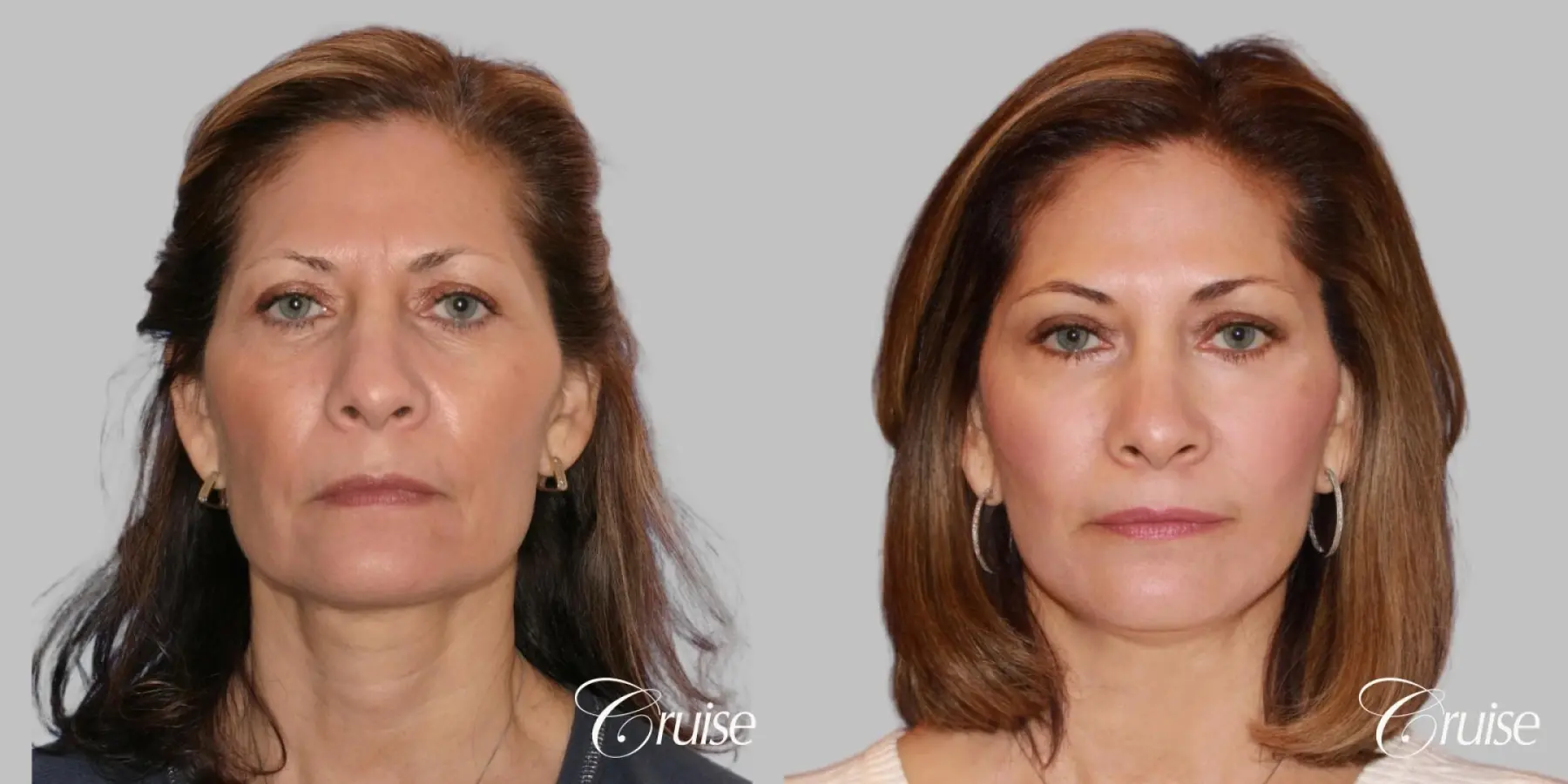 Face Lift, Fat Transfer, Temple Lift - Before and After  