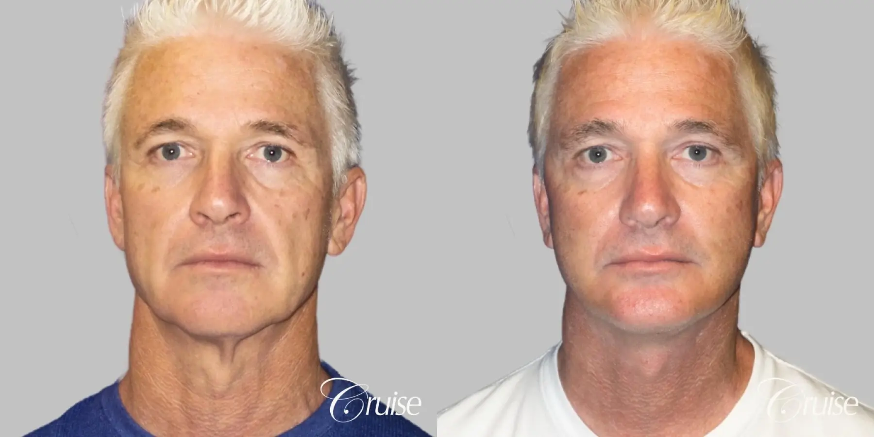 Male neck lift before and after - Before and After 1