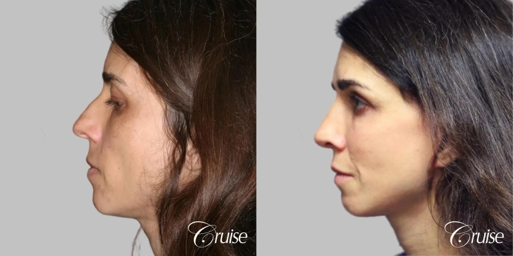 complete facial rejuvenation orange county - Before and After 2