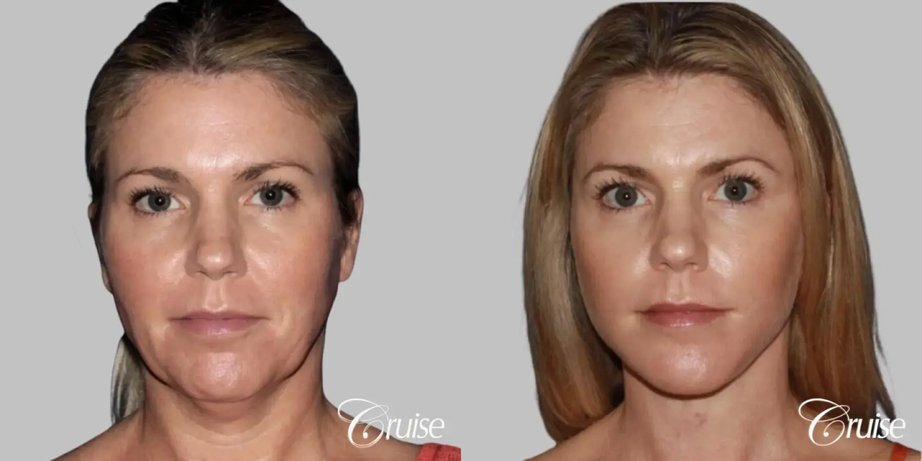 lower facelift with chin liposuction - Before and After 1