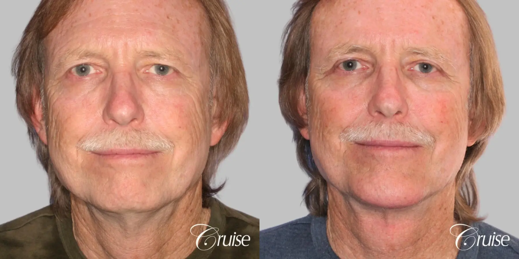 Male - Lower Face Lift, Neck Lift - Before and After 1