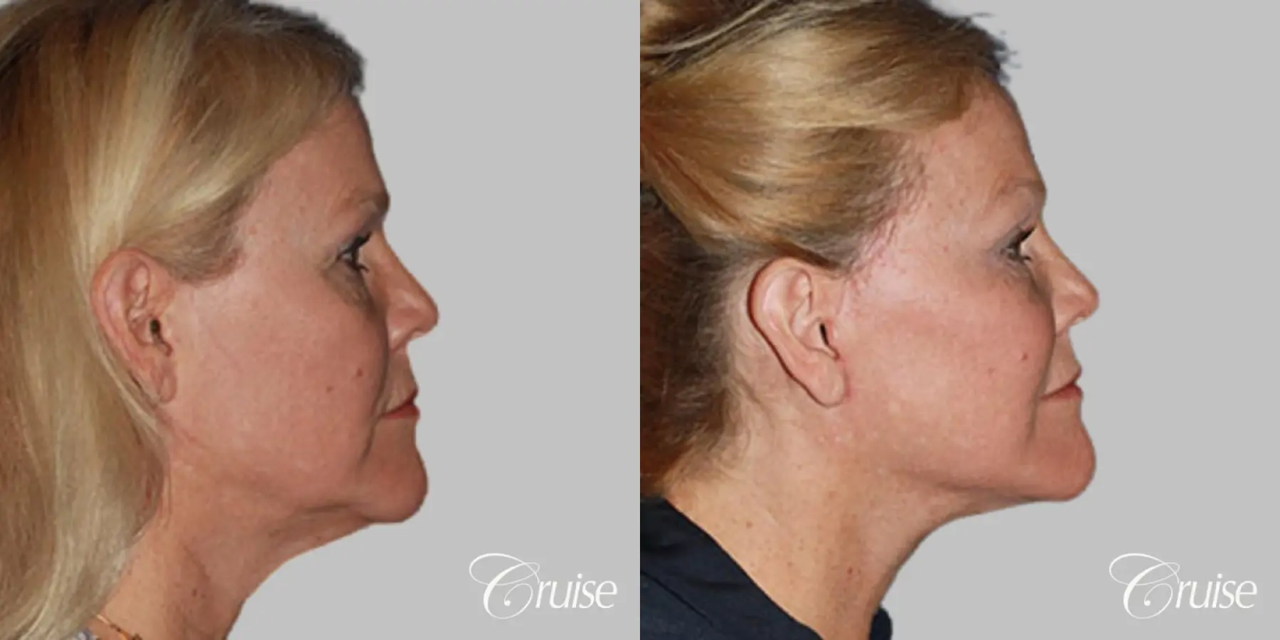 Facelift in Newport Beach, CA - Before and After 3