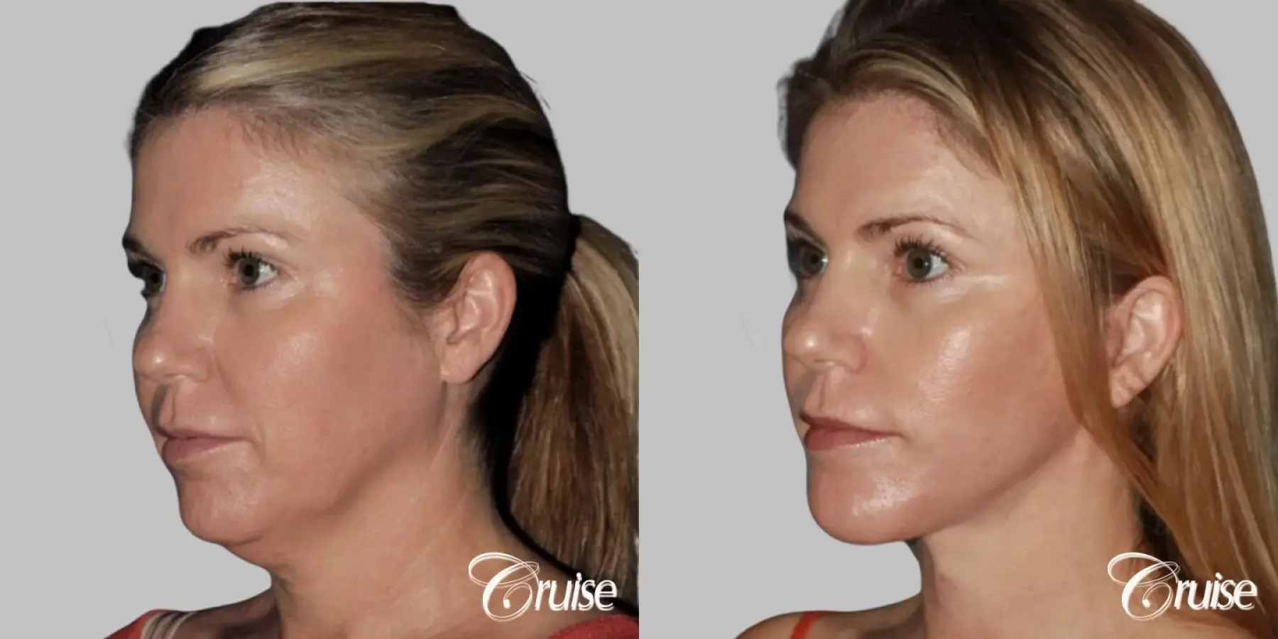 lower facelift with chin liposuction - Before and After 3