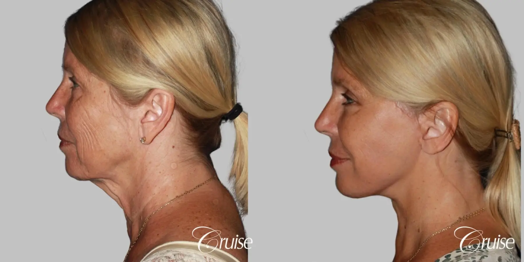 Face Lift, Neck Lift, Neck Midline Plication Surgery - Before and After 4