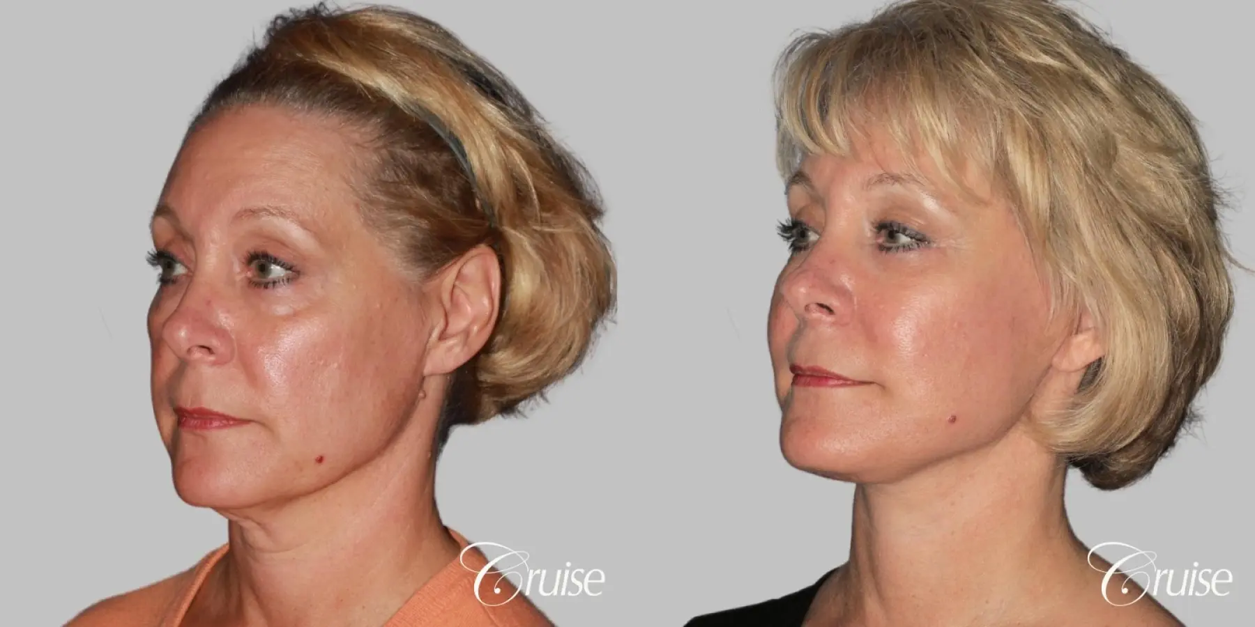 Female Facelift, Temple Lift, Fat Transfer, Neck Lift - Before and After 2