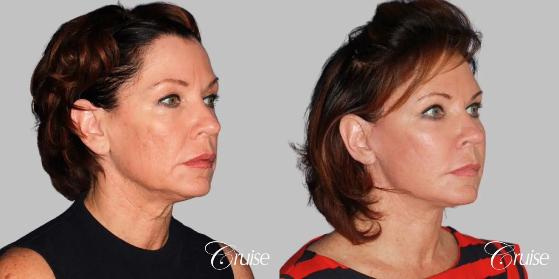 lower face and neck lift dr. joseph cruise - Before and After 2