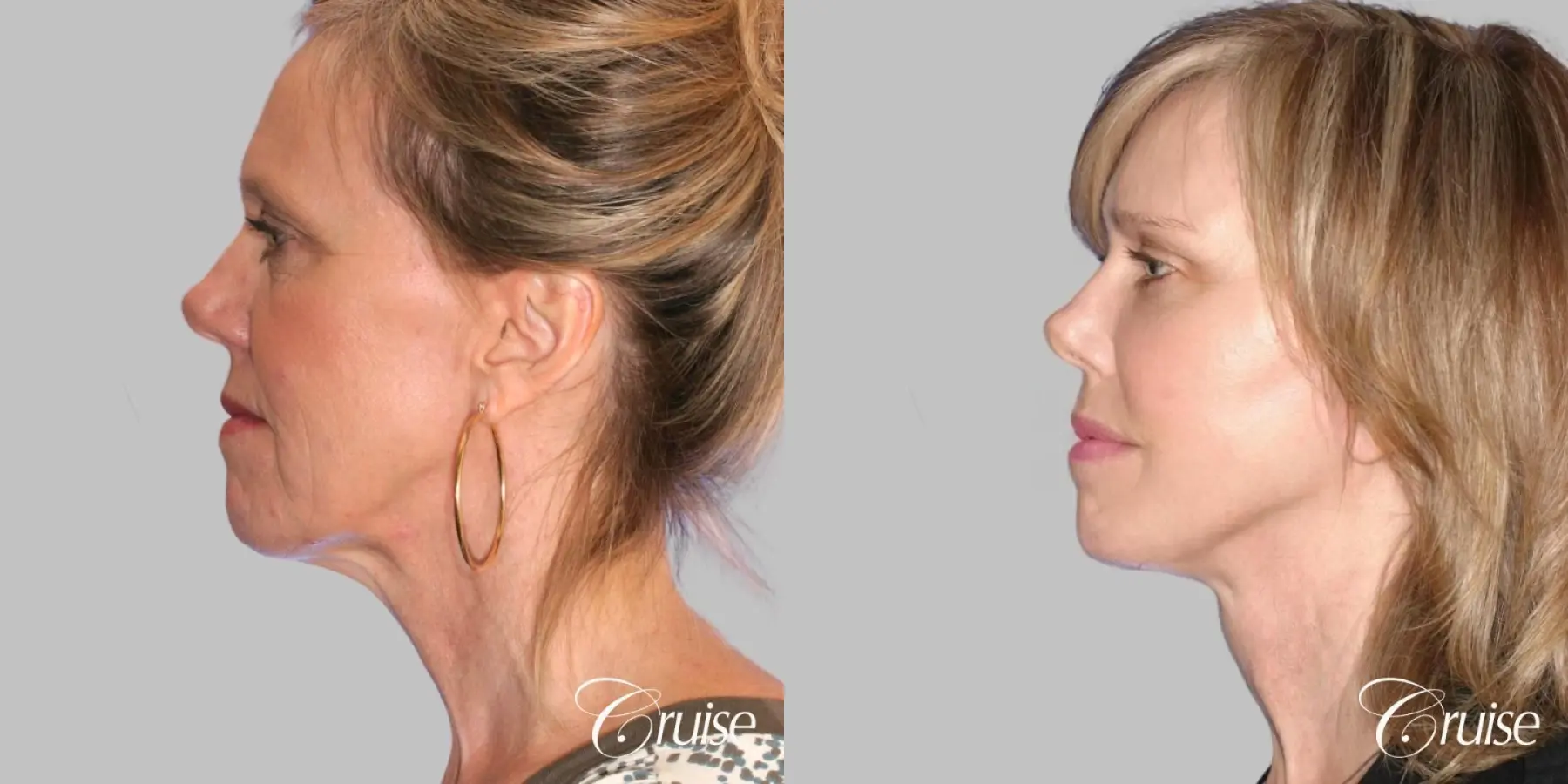 Female Facelift, NeckLift, Neck Midline Plication, Fat Transfer - Before and After 3