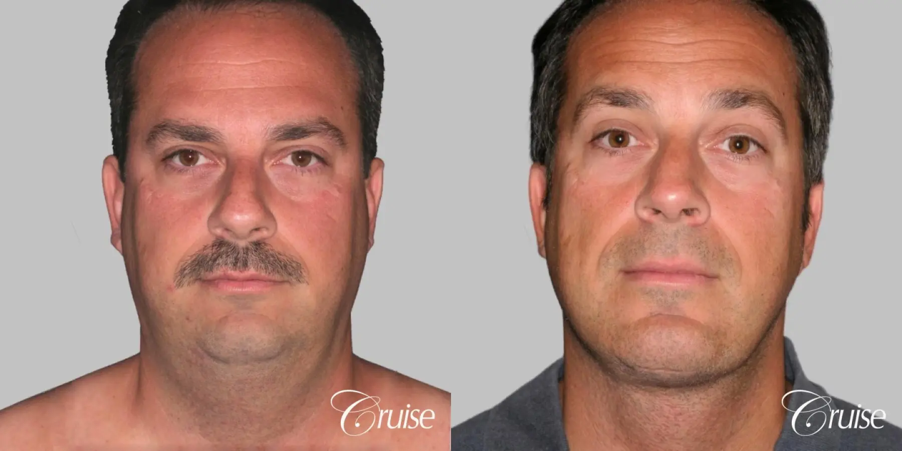 Male - Face Lift, Neck Lift, Chin Augmentation  with Liposuction - Before and After 1