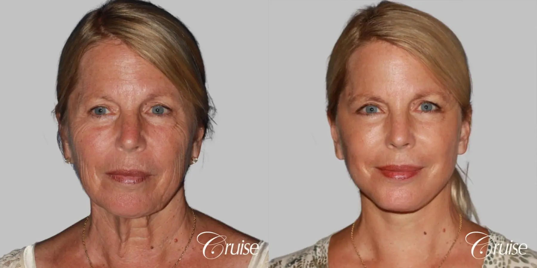 Face Lift, Neck Lift, Neck Midline Plication Surgery - Before and After  