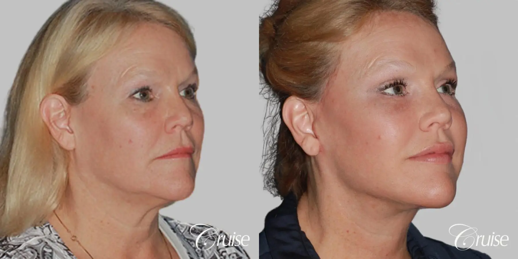 Facelift in Newport Beach, CA - Before and After 2