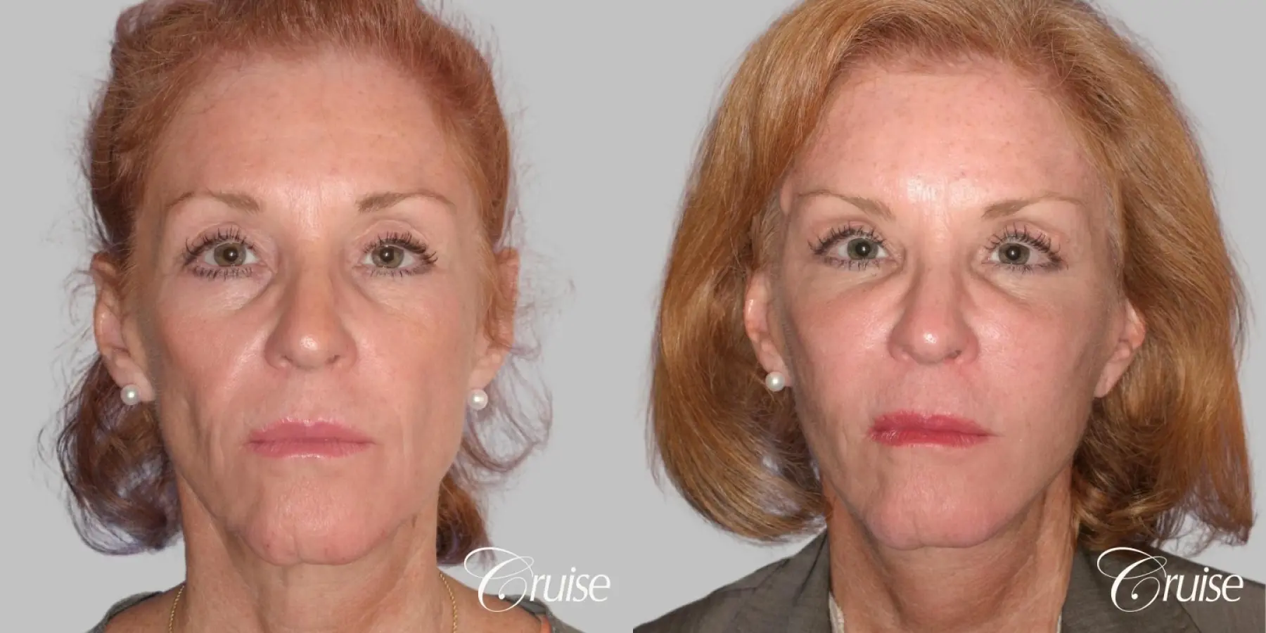 Facelift, Necklift, Temple Lift, Fat Transfer - Before and After 1