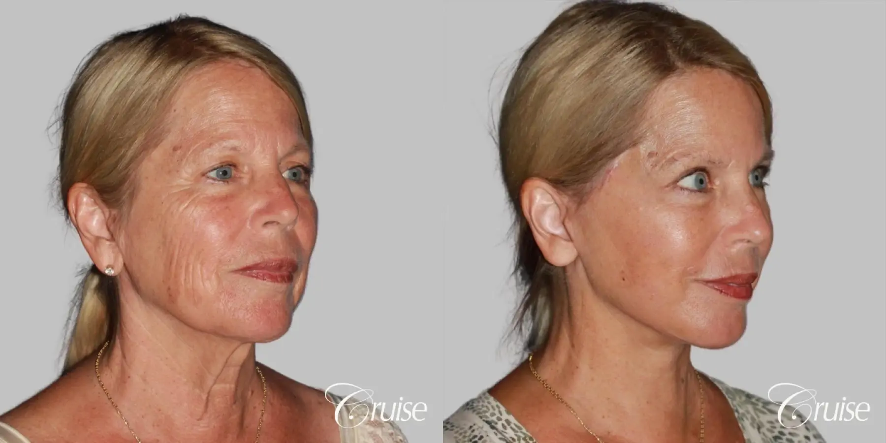 Face Lift, Neck Lift, Neck Midline Plication Surgery - Before and After 3