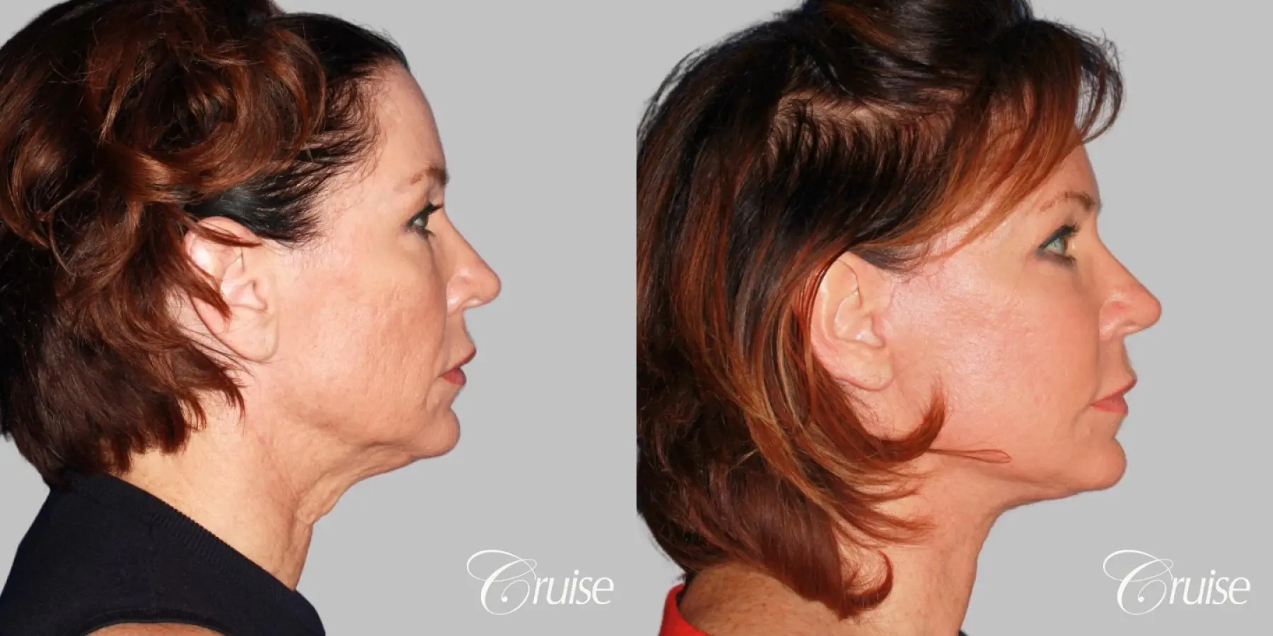 lower face and neck lift dr. joseph cruise - Before and After 4