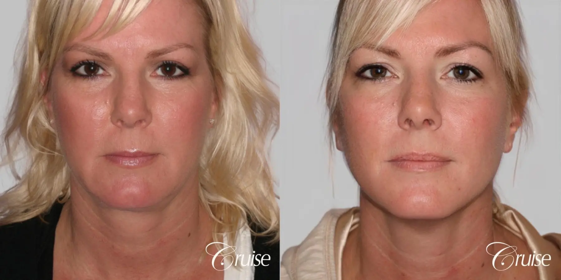 Facelift, Necklift, Lipo Neck and Jawline - Before and After  