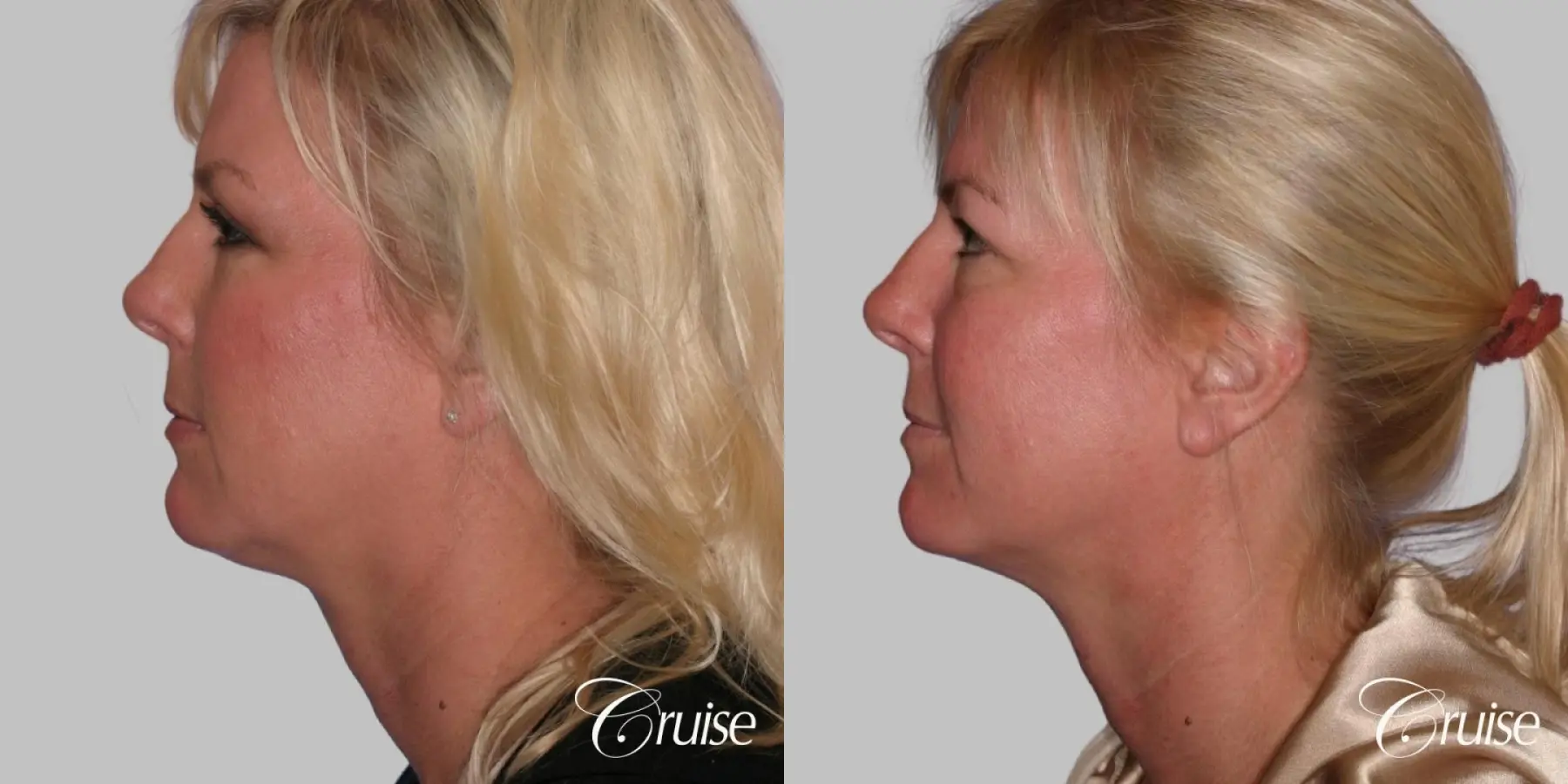 Facelift, Necklift, Lipo Neck and Jawline - Before and After 3