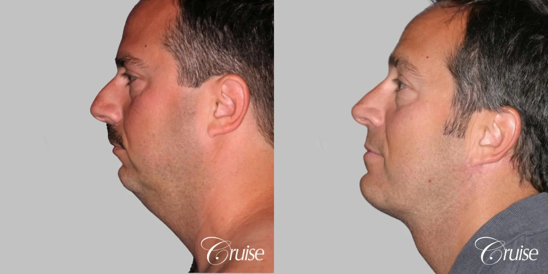 Male - Face Lift, Neck Lift, Chin Augmentation  with Liposuction - Before and After 2