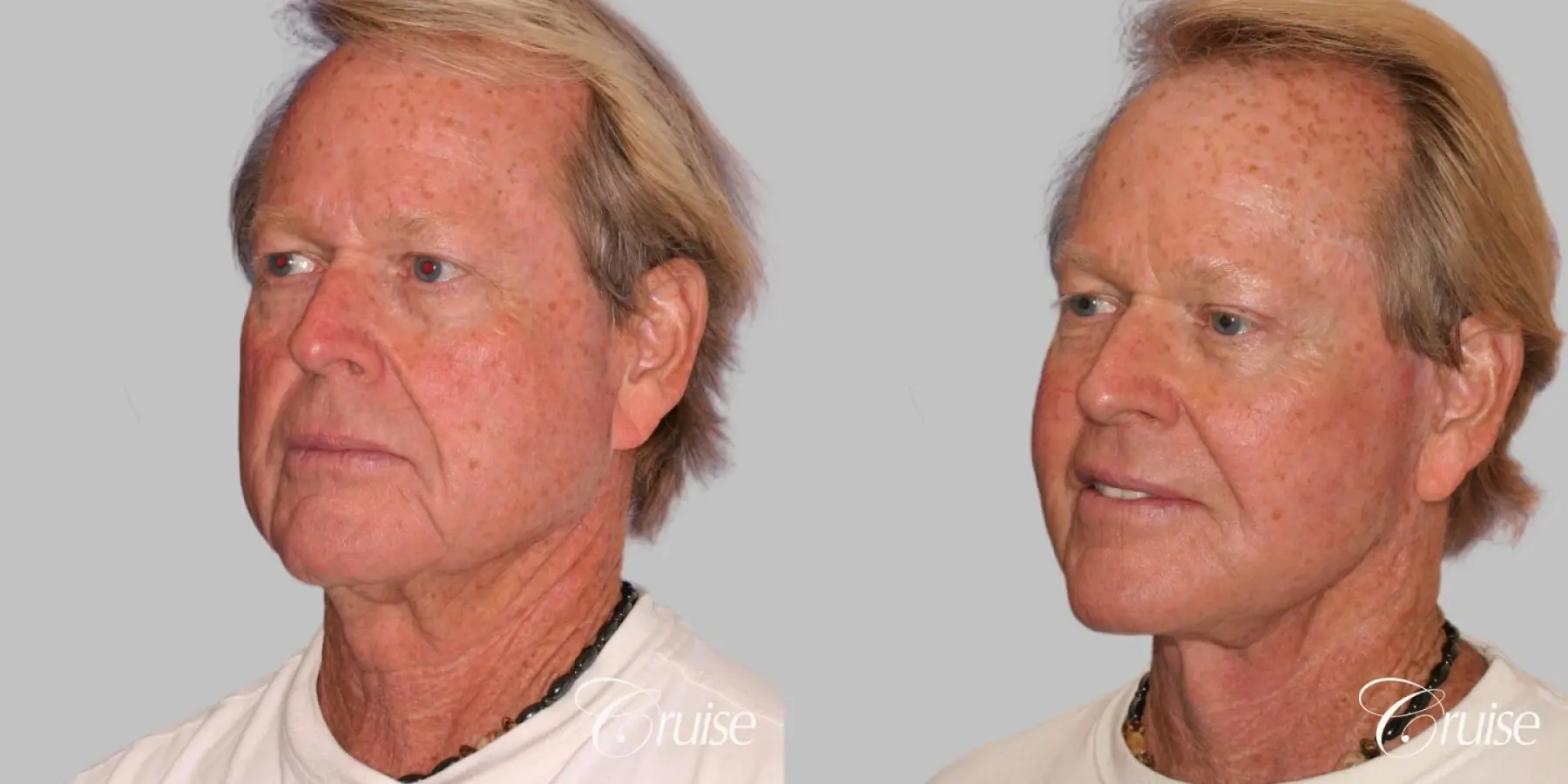 Male Facelift, Necklift, Fat Transfer, Temple Lift - Before and After 2