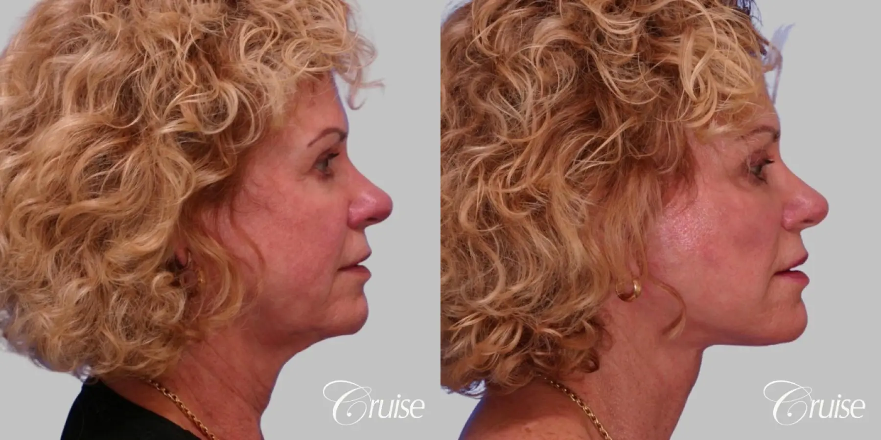 Facelift, Neck Midline Plication - Female Patient - Before and After 3