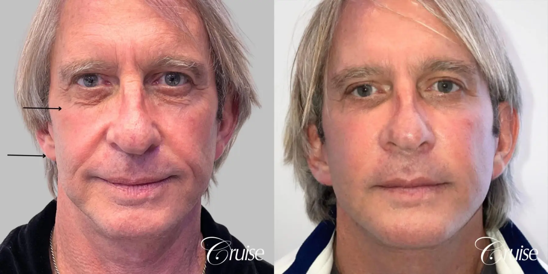 Fat Transfer - Cheeks, Tear Trough, Nasal Labial Folds - Male Patient - Before and After  