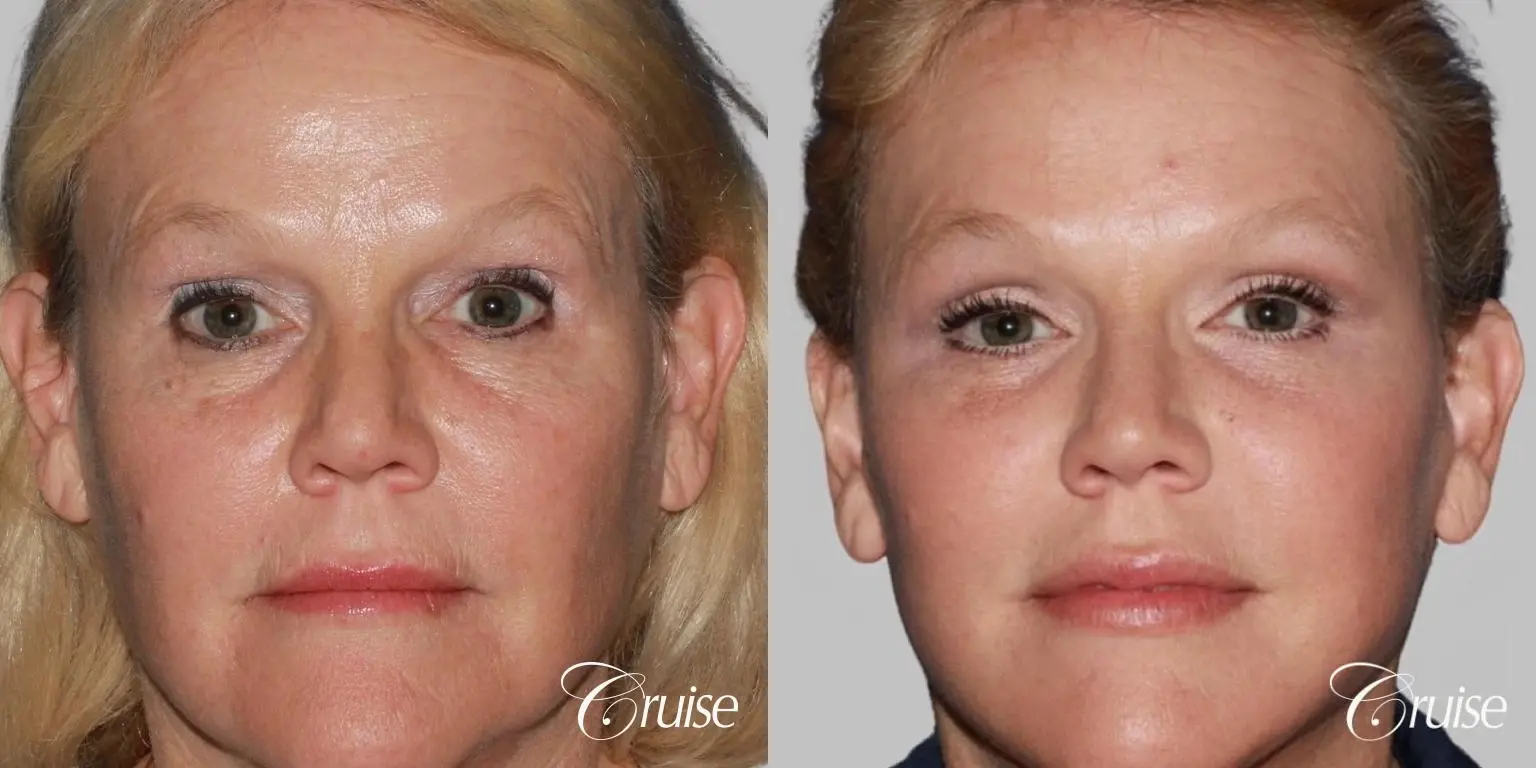 Facelift in Newport Beach, CA - Before and After