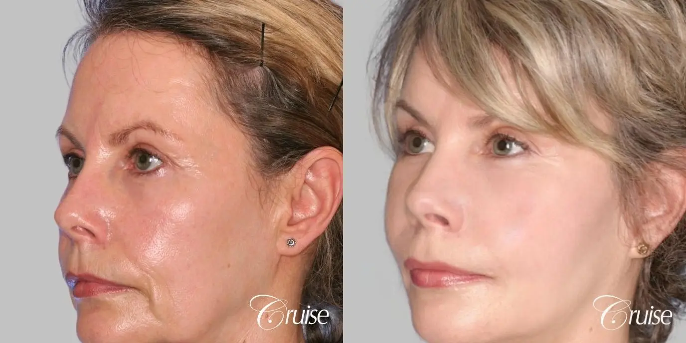 Facelift in Newport Beach, CA - Before and After 3