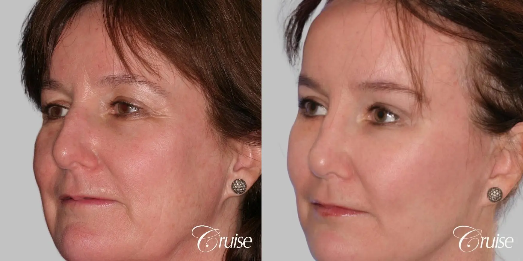 Facelift, Necklift, Fat Transfer - Before and After 3