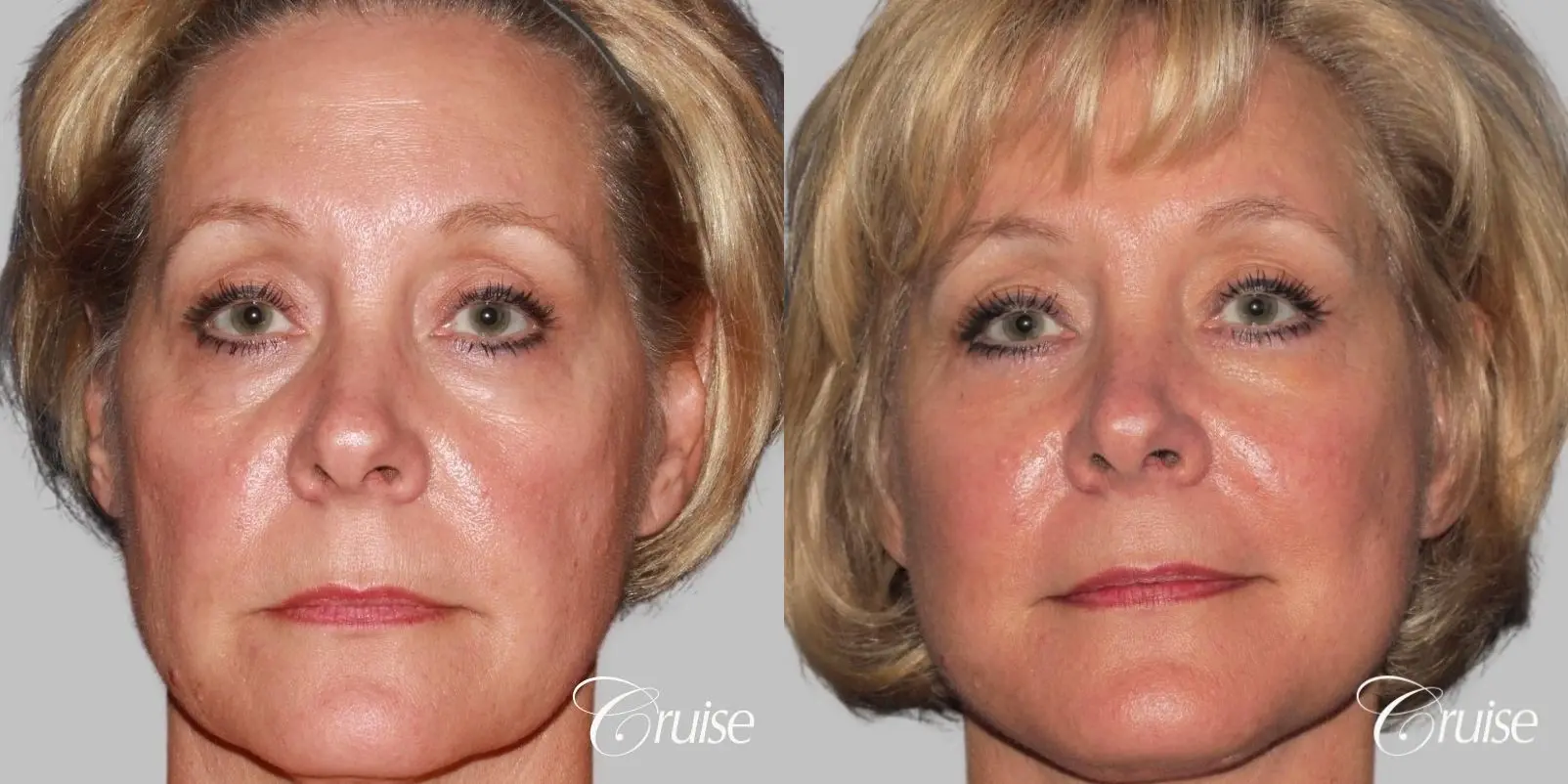 Female Facelift, Temple Lift, Fat Transfer, Neck Lift - Before and After  