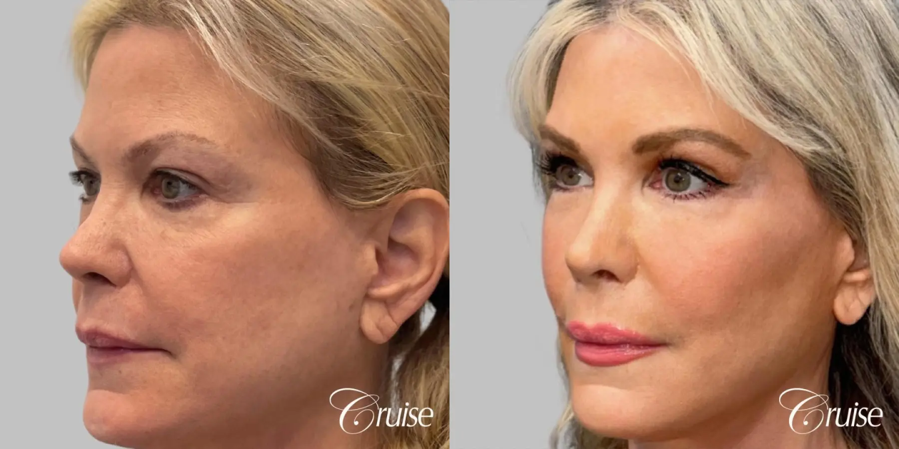 Female Fat Transfer - Cheeks, Upper and Lower Lips - Before and After 2