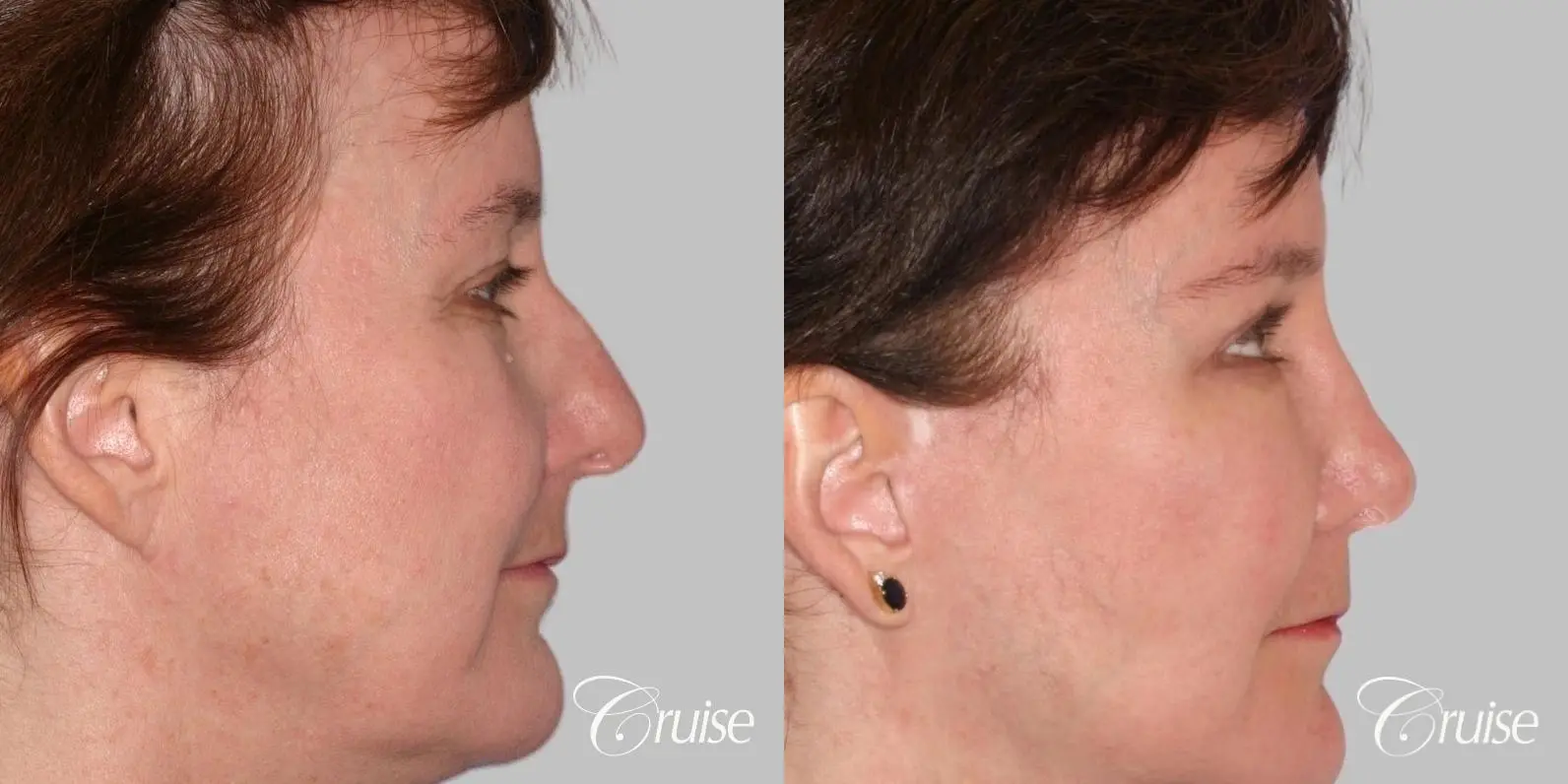 Facelift, Necklift, Fat Transfer - Before and After 2