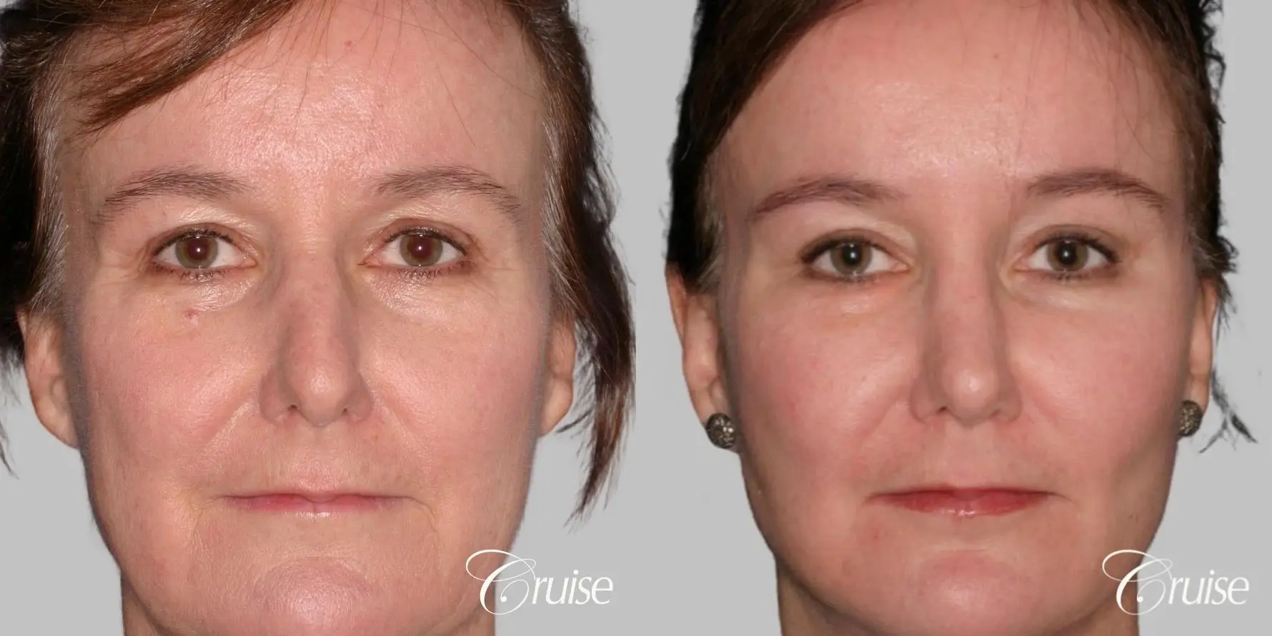 Facelift, Necklift, Fat Transfer - Before and After 1