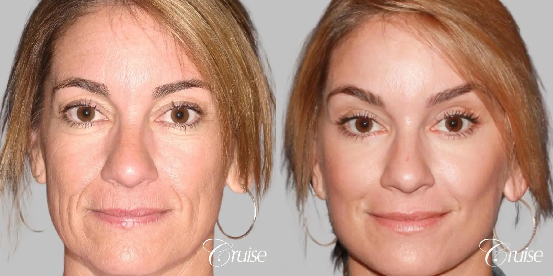 Female - Facelift, Neck Tightening, Fat Transfer - Before and After  