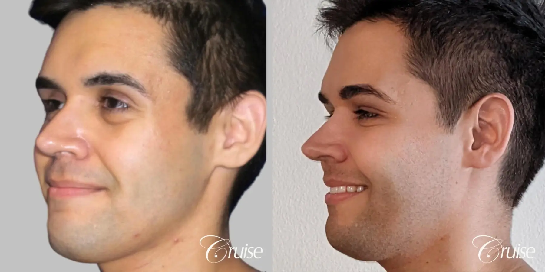 Male - Fat Transfer to Cheeks, Temple, and Tear Trough - Before and After 2