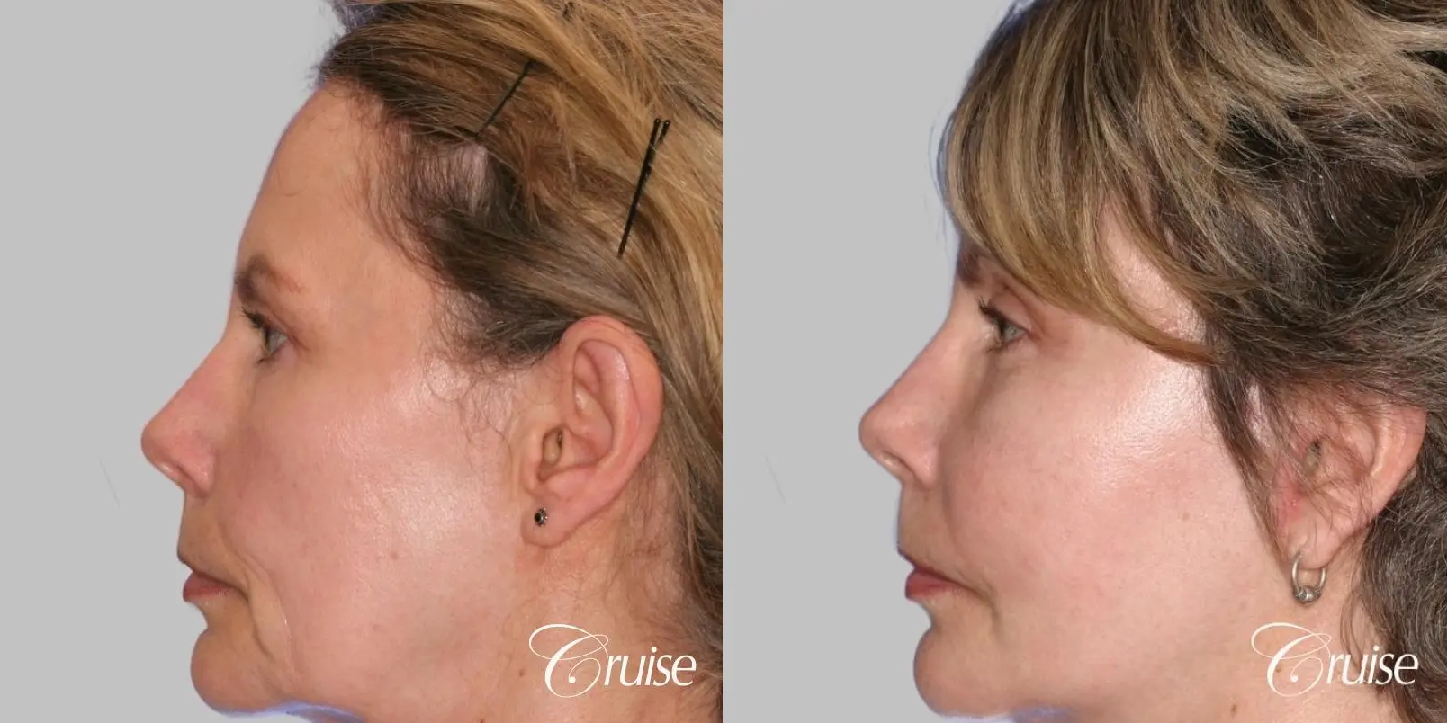 Facelift in Newport Beach, CA - Before and After 2