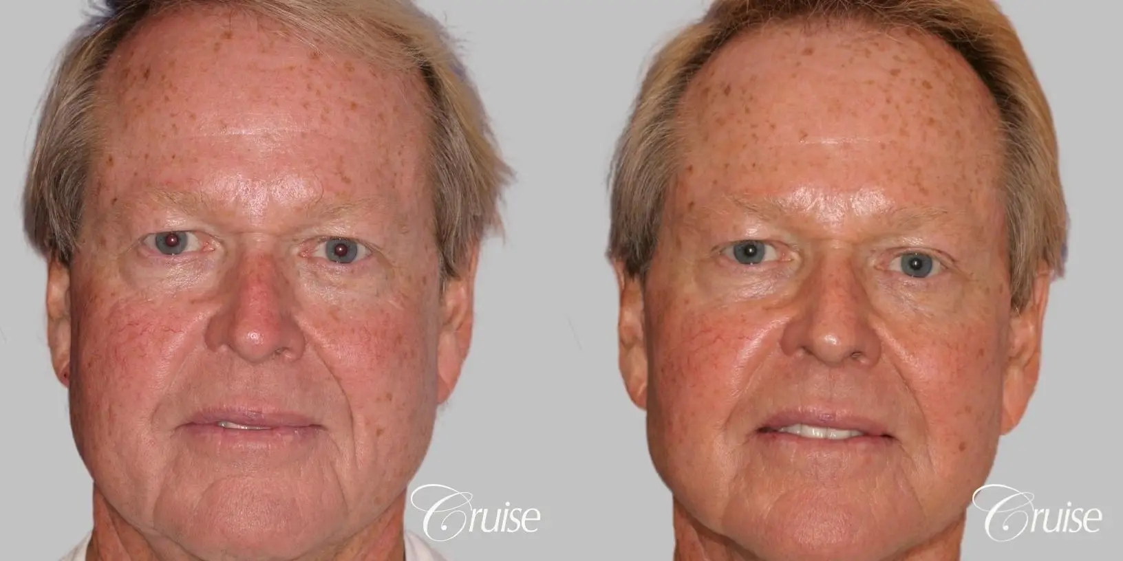 Male Facelift, Necklift, Fat Transfer, Temple Lift - Before and After  