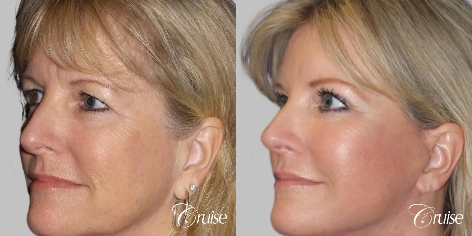 Face Lift surgery Newport Beach Orange County - Before and After 2