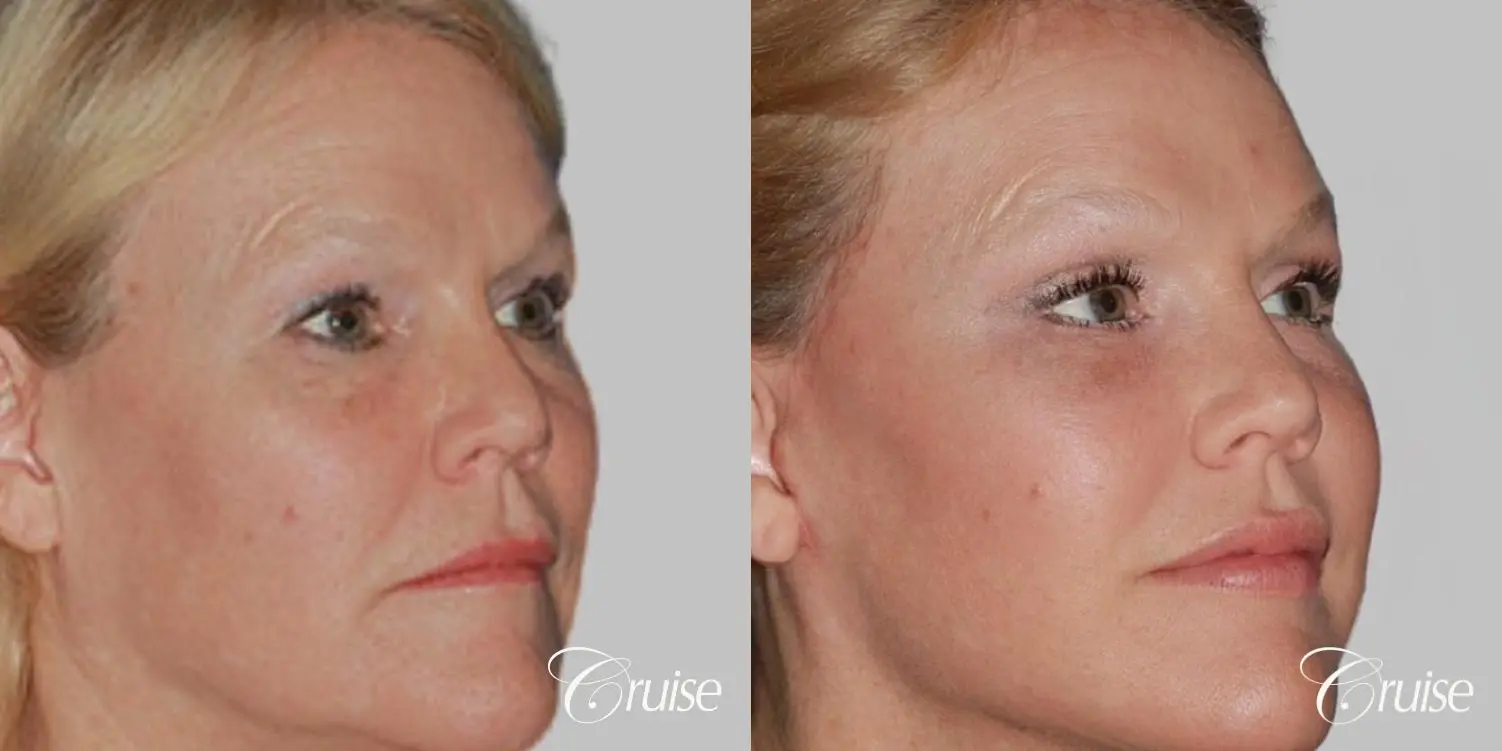 Facelift in Newport Beach, CA - Before and After 2