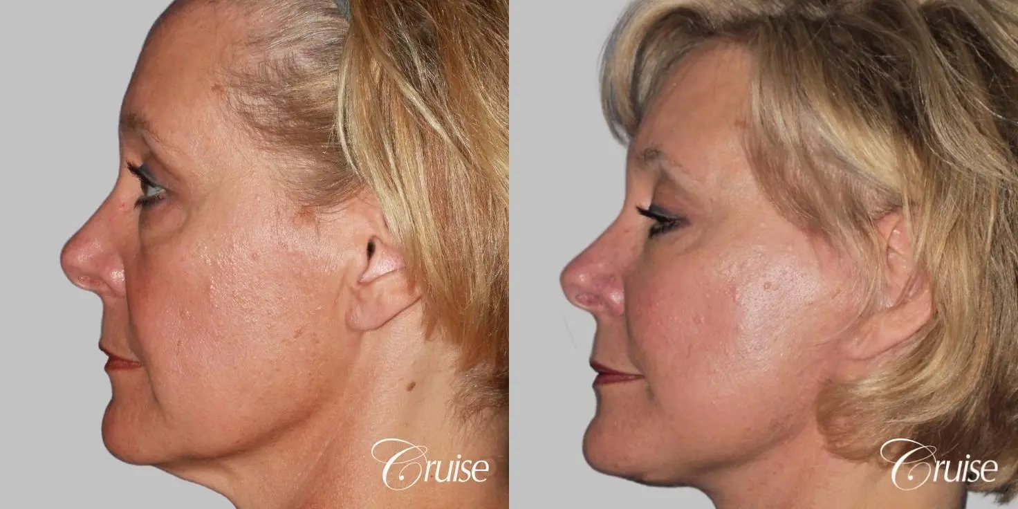 Female Facelift, Temple Lift, Fat Transfer, Neck Lift - Before and After 3