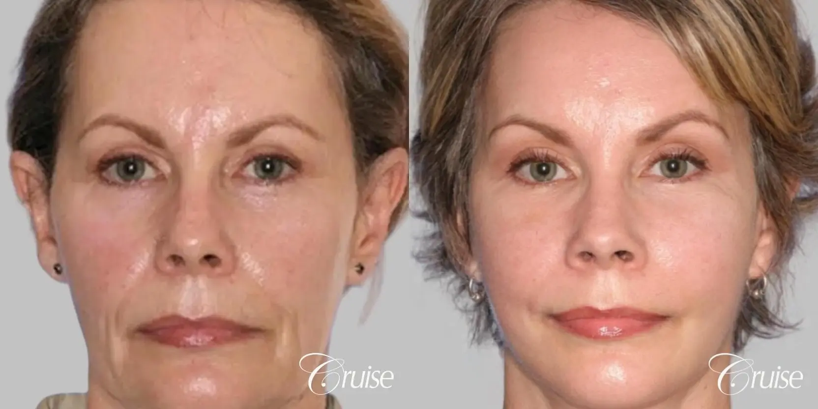 Facelift in Newport Beach, CA - Before and After 1