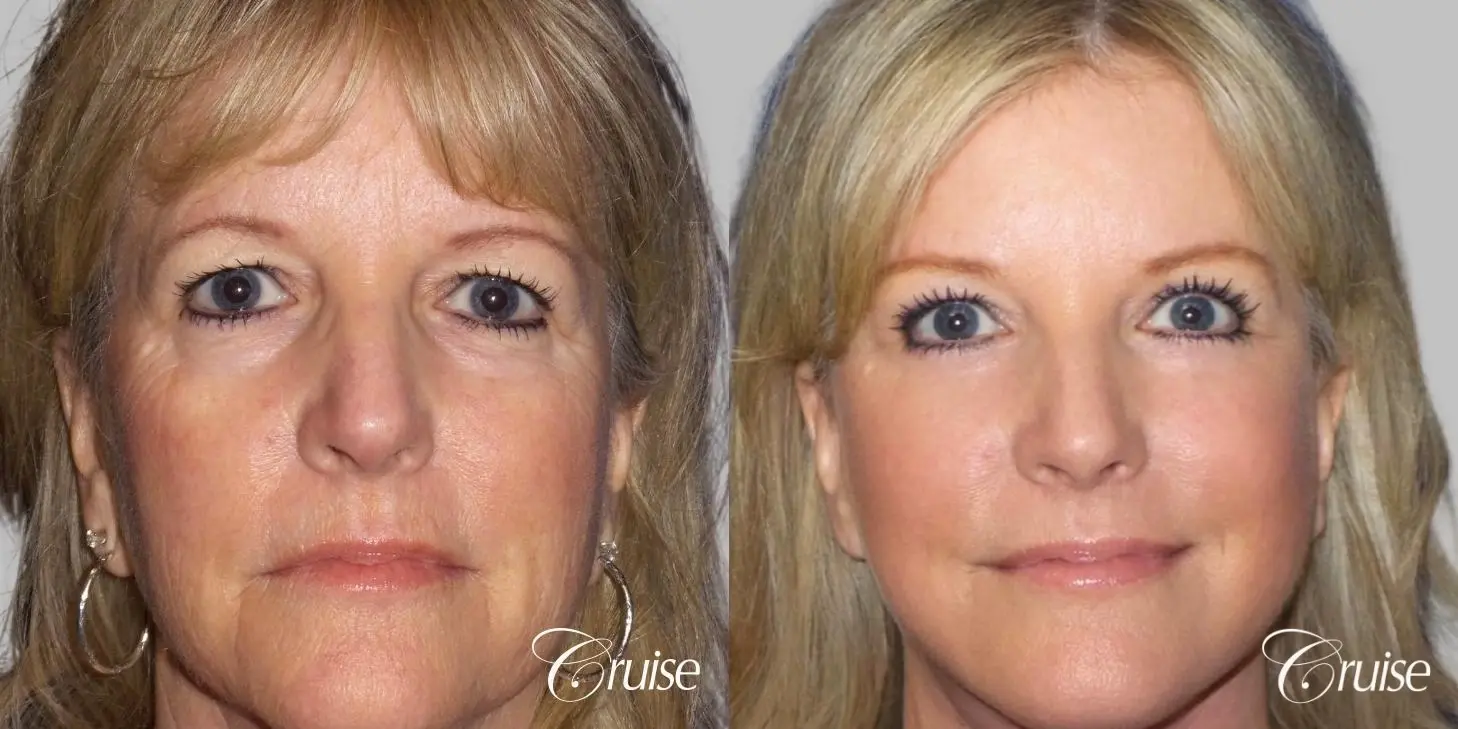 Face Lift surgery Newport Beach Orange County - Before and After